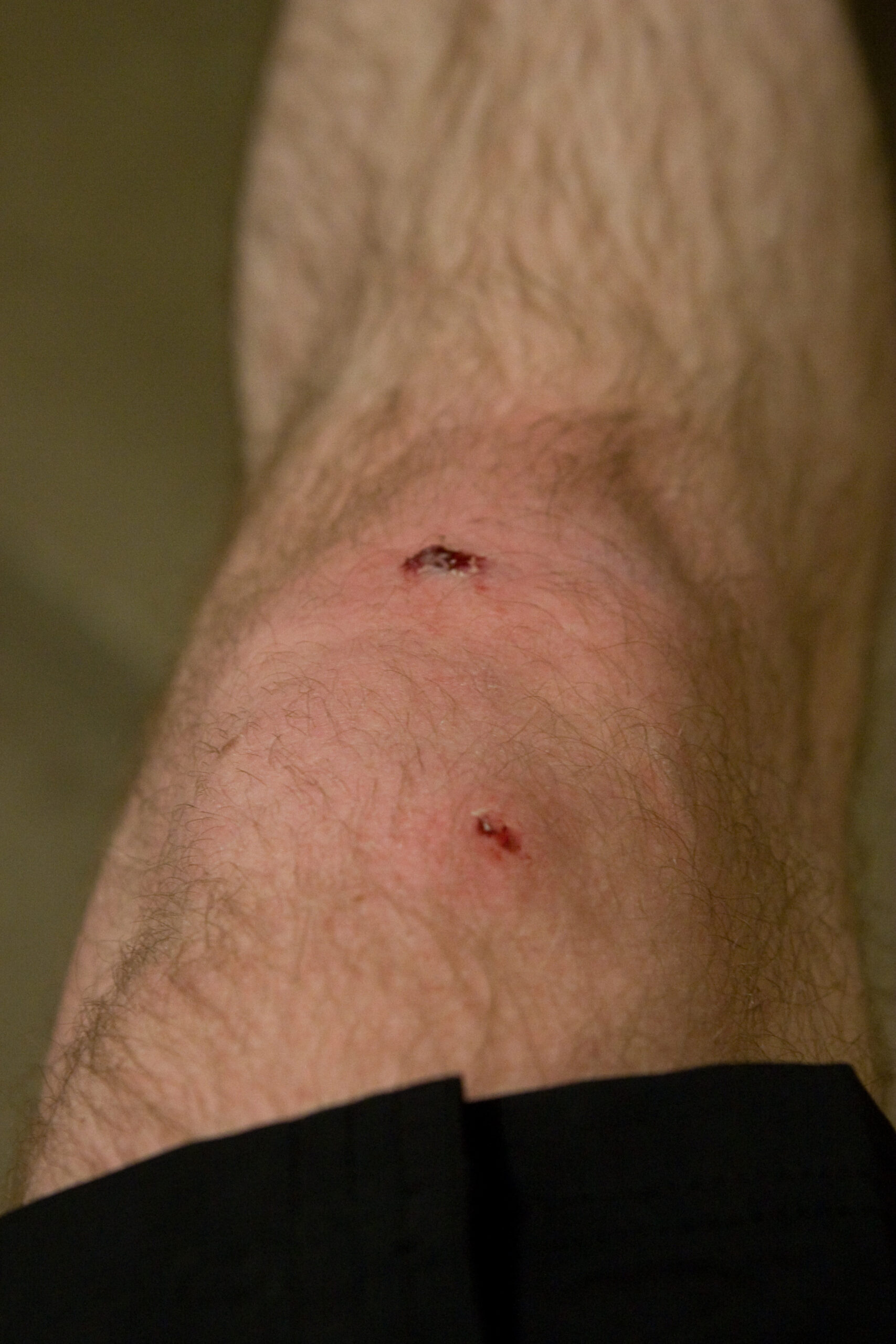 My knee after falling twice while getting comfortable with clipless pedals. The upper (closer) injury is a puncture wound from the brake lever and the lower is from the pavement. Both happened while stopping and failing to unclip my right foot.