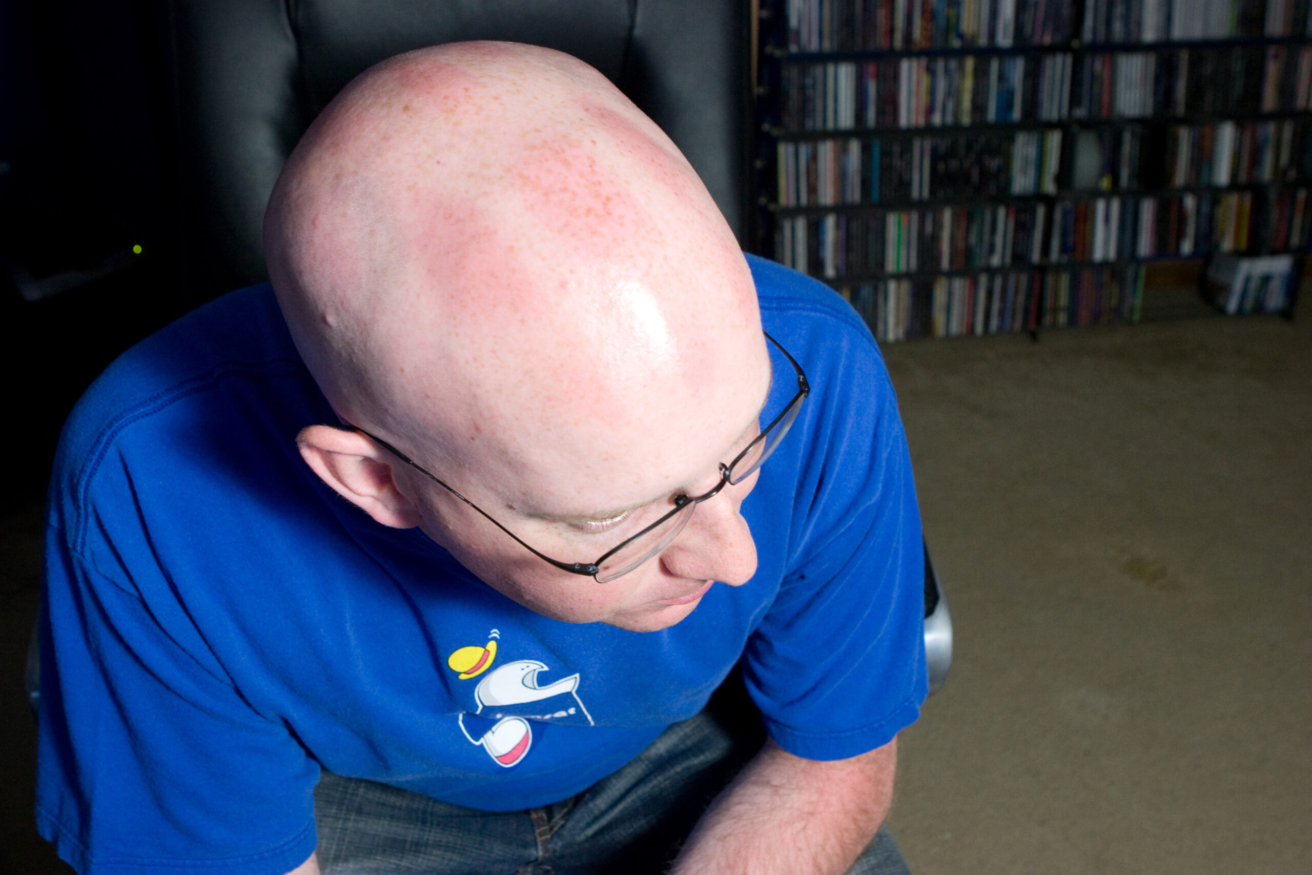 My head, with sunburn spots on it, from wearing a helmet while riding ~41 miles on 24-May-2008.