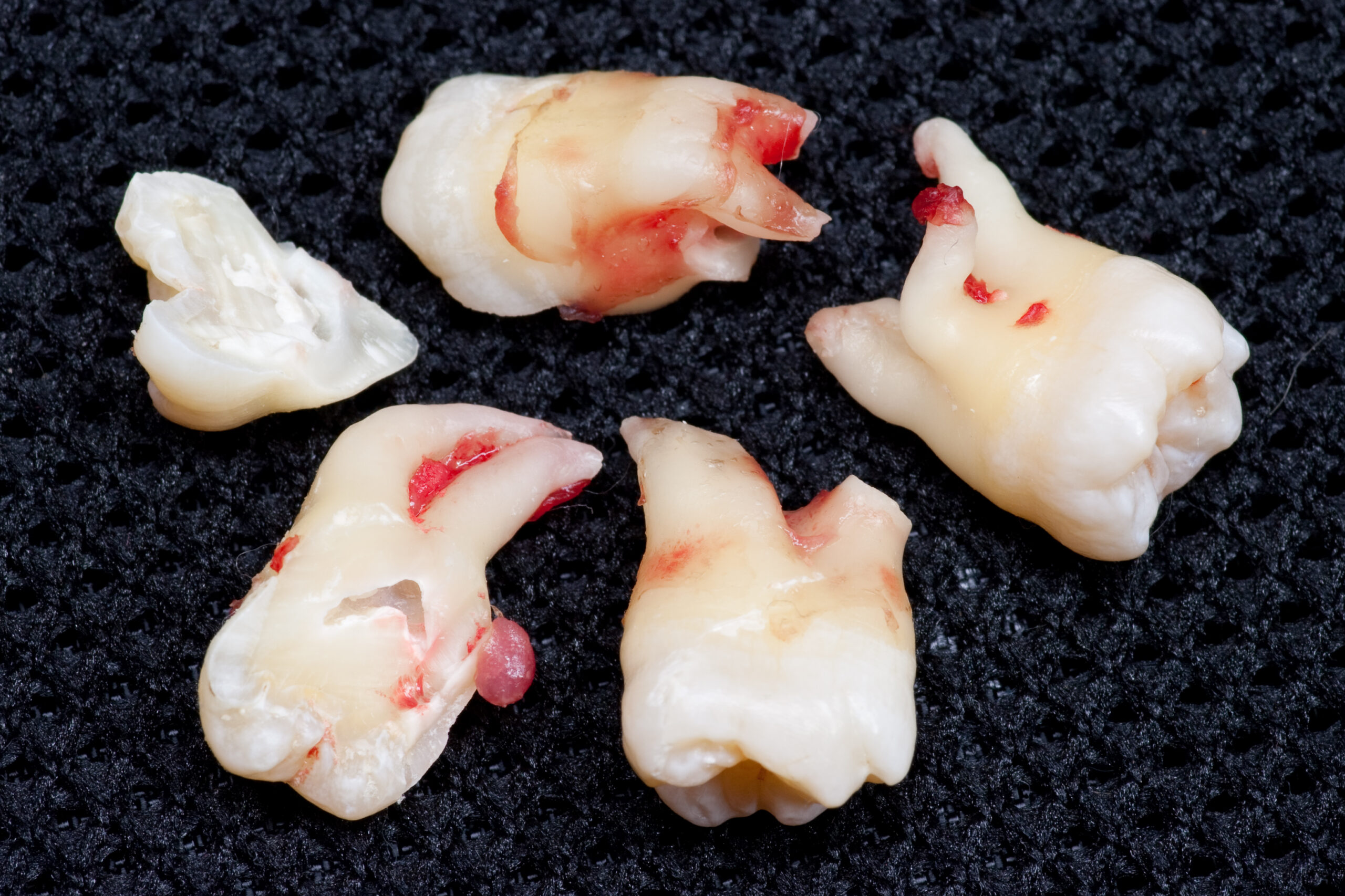 Danielle's wisdom teeth, not long after extraction. All four were impacted.