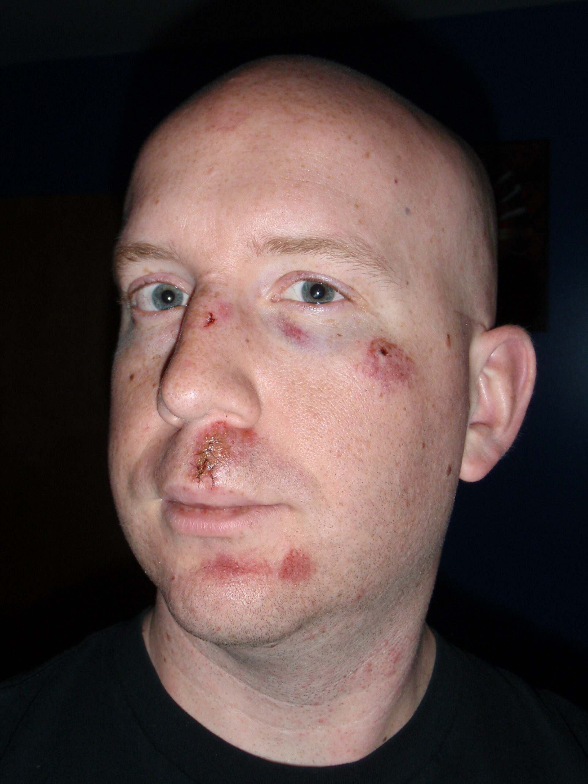 The next day shows a bruised cheek bone, slightly blackened eye, and some other bruising in conjunction with the stitches.
