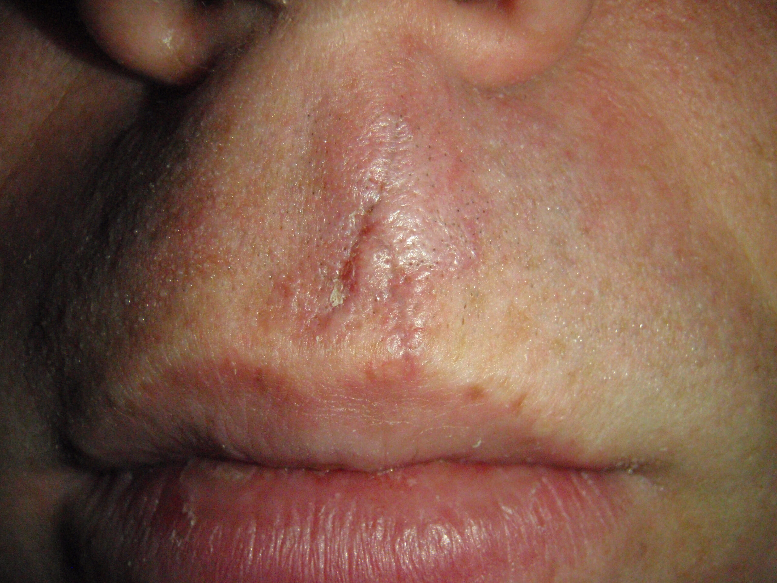 Showing the scar / residual cut after shaving. It felt really, really good to finally shave.