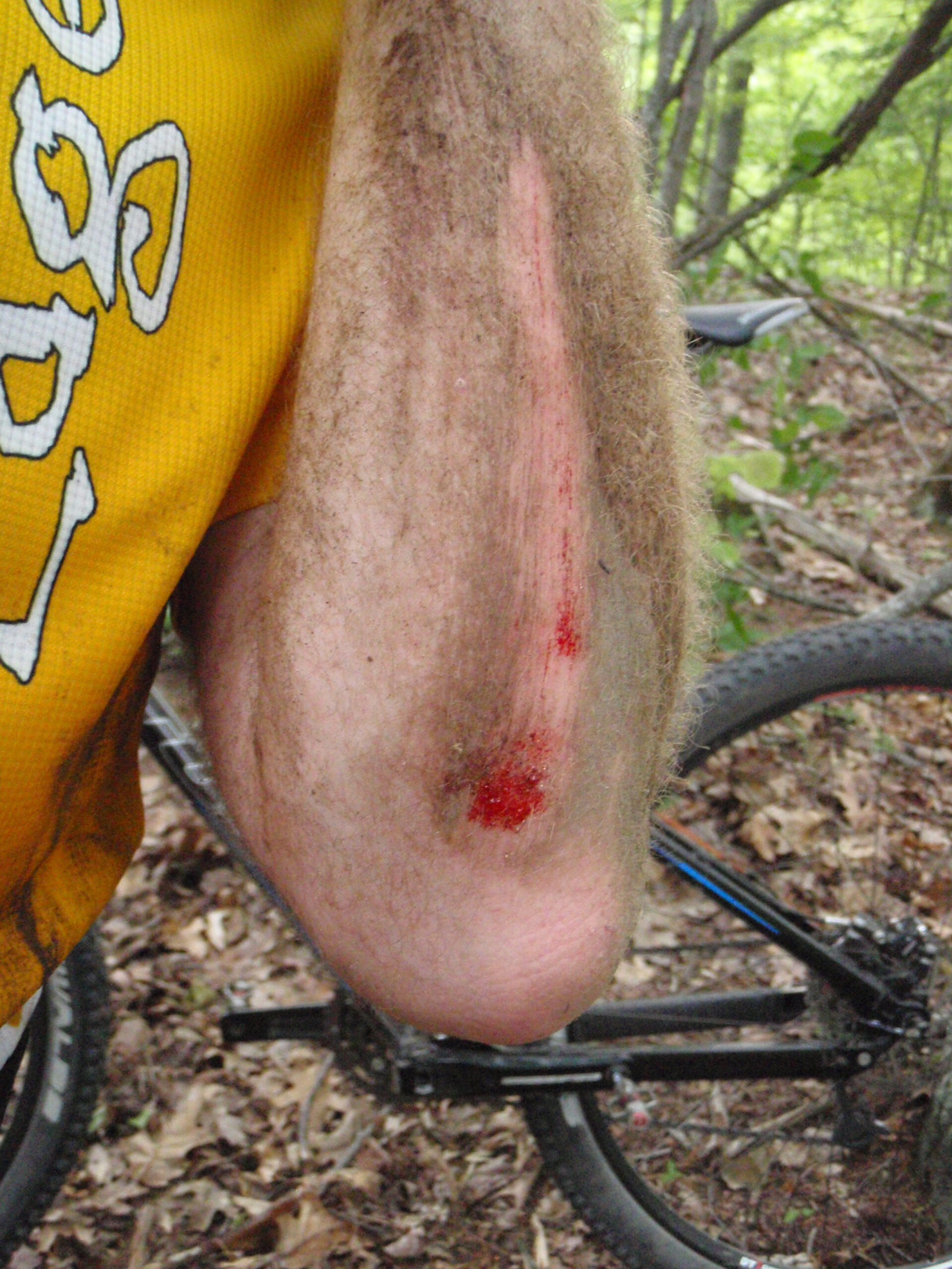 Detail of the scrapes on my arm after falling at Addison Oaks.