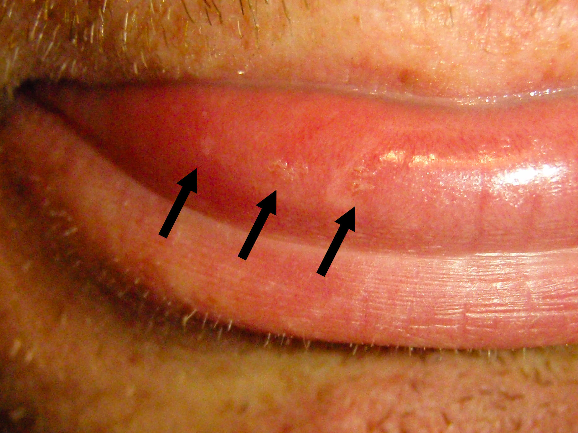 Three bite / sting marks on my lip from when an unknown insect flew into my mouth, got stuck between my lips, and bit / stung me.